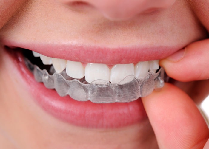 Discover The Invisalign Arlington Solution To A Healthier Smile And Healthier Teeth  