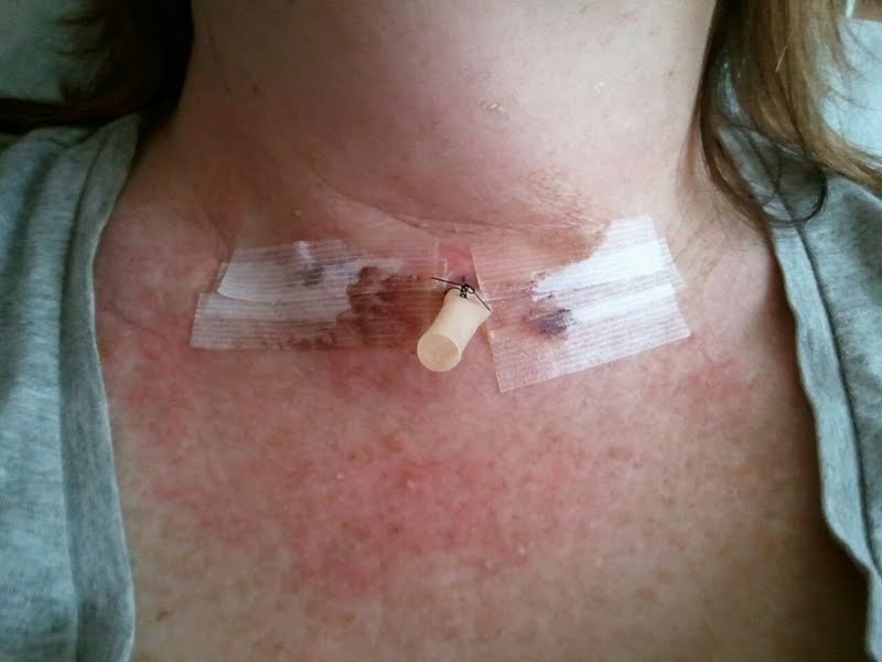 Surgery To Remove Thyroid Cancer