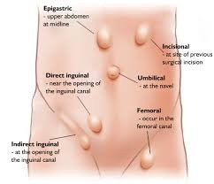 The problems a hernia can cause and its treatment