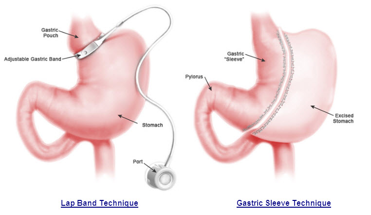 What is Gastric Banding Revision Surgery?