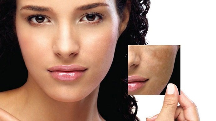 Causes of pigmentation