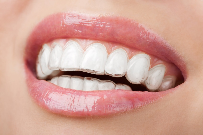 Invisalign Dental Bracings