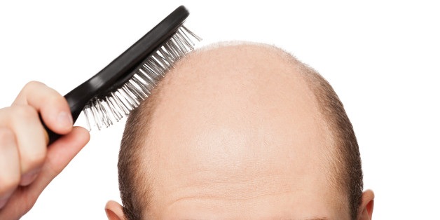 3 Basic Points: How Hair Transplant Solves Baldness