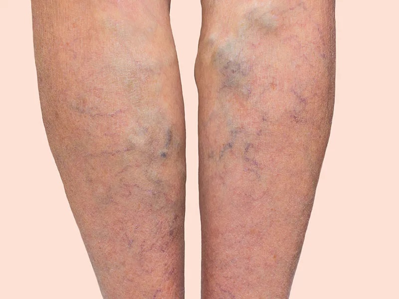 All about varicose veins