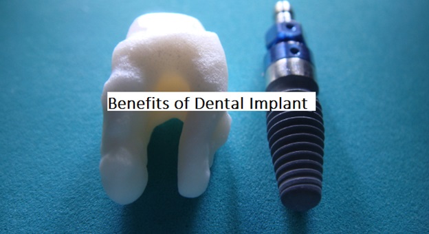 Benefits of Dental Implant