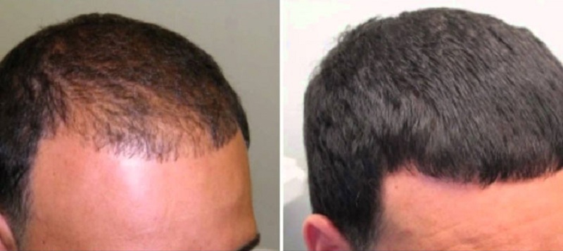 Effects after use of progaine shampoo