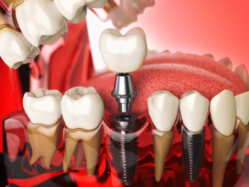 Restoring the Confidence in your Smile with Dental Implants