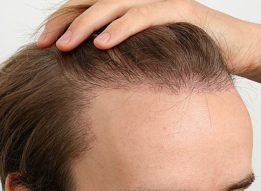 QUЕЅTIОNЅ TО AЅK BEFORE HAVING A HAIR TRANSPLANT