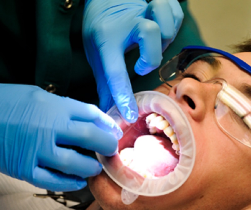 Why to Have Wisdom Teeth Removal in Australia?