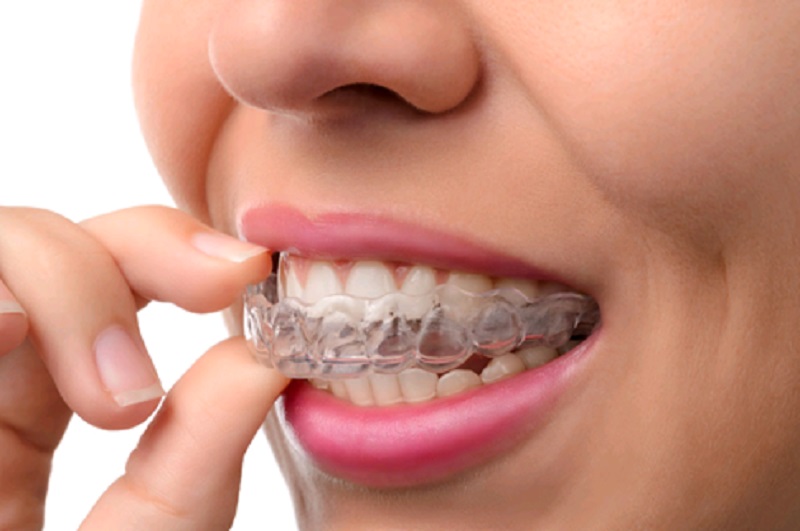 Why Choose Invisible Braces Over Metal Braces?