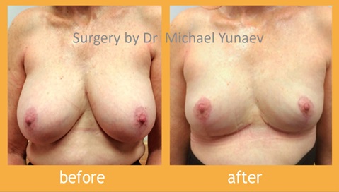 Reduce Your Breasts And Return Time On Your Looks