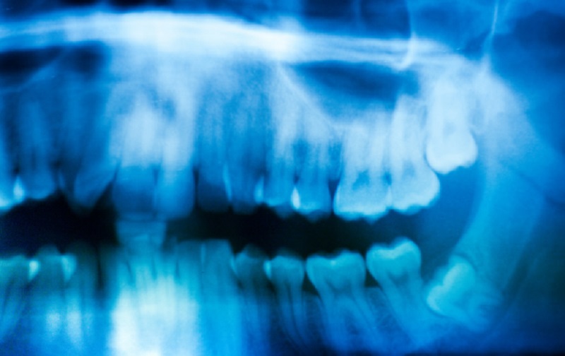 Wisdom Teeth Removal – Why Prevention Is Better Than Waiting for the Problem to Occur