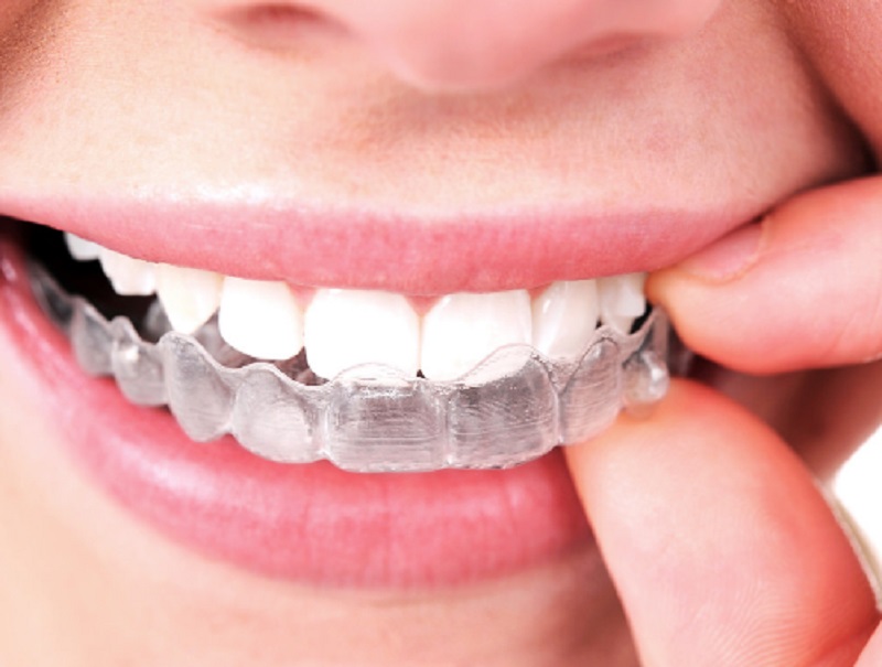 Are Invisible Braces For Me?