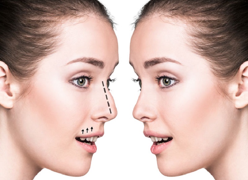 All You Need to Know About Nose Correction Job