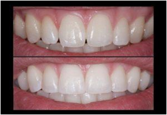 Enhance Your Smile with Composite Bonding – Here are 5 Benefits