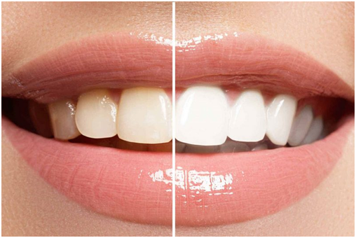 Teeth Whitening Procedure – Explained