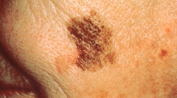 Skin cancer screening get your skin examined