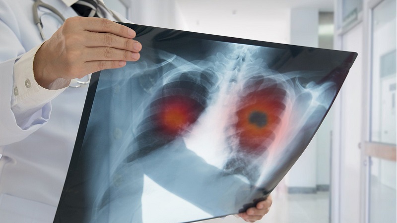 Know everything on Lung Cancer- Asbestos test
